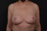 Breast Revision - Case #77 After
