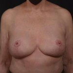 Breast Revision - Case #77 After