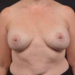 Breast Revision - Case #79 Before