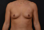 Breast Augmentation - Case #112 Before