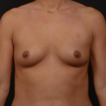 Breast Augmentation - Case #112 Before