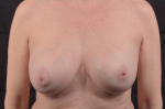 Breast Revision - Case #69 Before