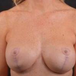 Breast Augmentation Mastopexy Revision - Case #48 Before