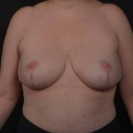 Breast Revision - Case #81 After