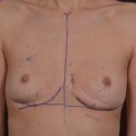 Breast Revision - Case #44 Before