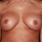 Breast Revision - Case #82 Before