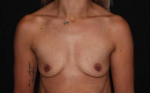 Breast Augmentation - Case #115 Before