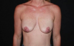 Breast Augmentation Mastopexy - Case #85 Before