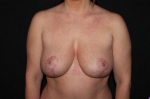 Mastopexy - Case #76 After