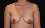 Breast Augmentation Mastopexy - Case #86 Before