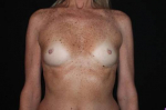 Breast Augmentation - Case #116 Before