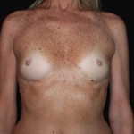 Breast Augmentation - Case #116 Before