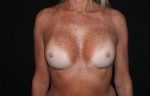 Breast Augmentation - Case #116 After