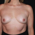 Breast Augmentation - Case #117 Before