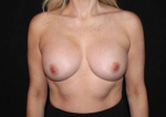 Breast Augmentation - Case #117 After