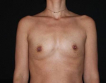 Breast Augmentation - Case #118 Before