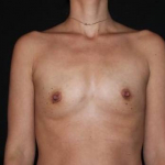 Breast Augmentation - Case #118 Before