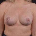 Breast Revision - Case #42 After