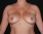 Breast Augmentation Mastopexy - Case #88 Before