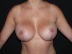 Breast Augmentation Mastopexy - Case #88 After