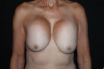 Breast Revision - Case #90 Before