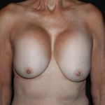 Breast Revision - Case #90 Before