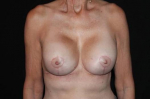Breast Revision - Case #90 After