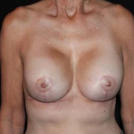 Breast Revision - Case #90 After