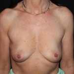 Breast Augmentation - Case #120 Before