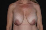 Breast Implant Removal and Mastopexy - Case #215 Before
