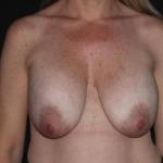 Breast Revision - Case #94 Before