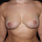 Breast Revision - Case #97 After