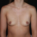 Breast Augmentation - Case #220 Before