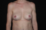 Breast Implant Removal and Mastopexy - Case #218 After