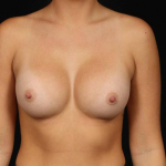 Breast Augmentation - Case #222 After