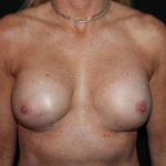 Breast Revision - Case #101 Before