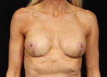 Breast Revision - Case #101 After
