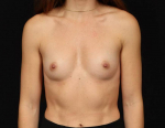Breast Augmentation - Case #223 Before