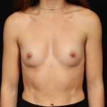 Breast Augmentation - Case #223 Before