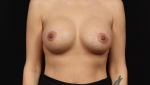 Breast Augmentation Mastopexy - Case #156 After