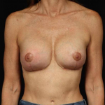 Breast Revision - Case #132 After
