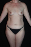Liposuction - Case #32 Before