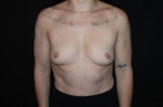 Breast Augmentation - Case #121 Before