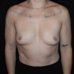 Breast Augmentation - Case #121 Before
