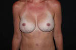 Breast Augmentation Mastopexy - Case #159 After