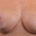 Breast Revision - Case #41a Before