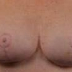 Breast Revision - Case #41a After