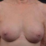 Breast Augmentation Mastopexy Revision - Case #39 After