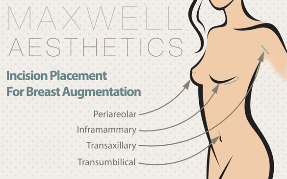 Breast augmentation at our Nashville, TN, practice can involve one of four incision locations: periareolar, transaxillary, transumbilical, or inframammary.