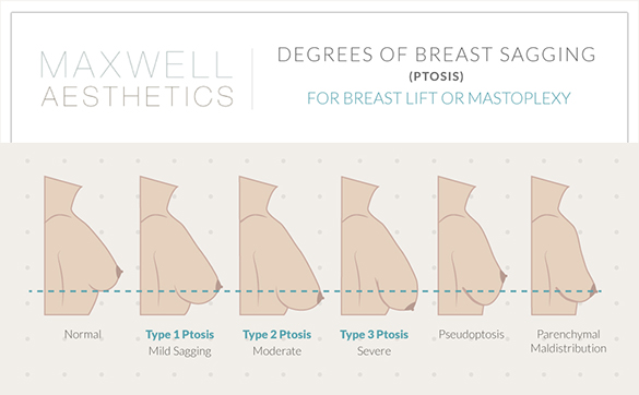 See the range of degrees of sagging that can be addressed with a breast lift at Nashville Plastic Surgery Institute.